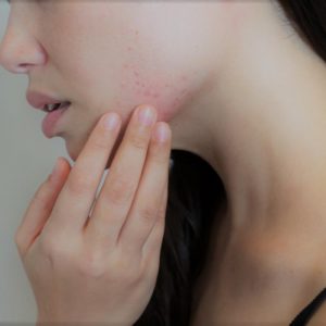 Maskne, acne da mascherina. Scopriamo cos’è e come curarla!